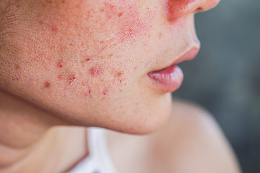 Remedios para el acné: rápidos, fáciles y efectivos 