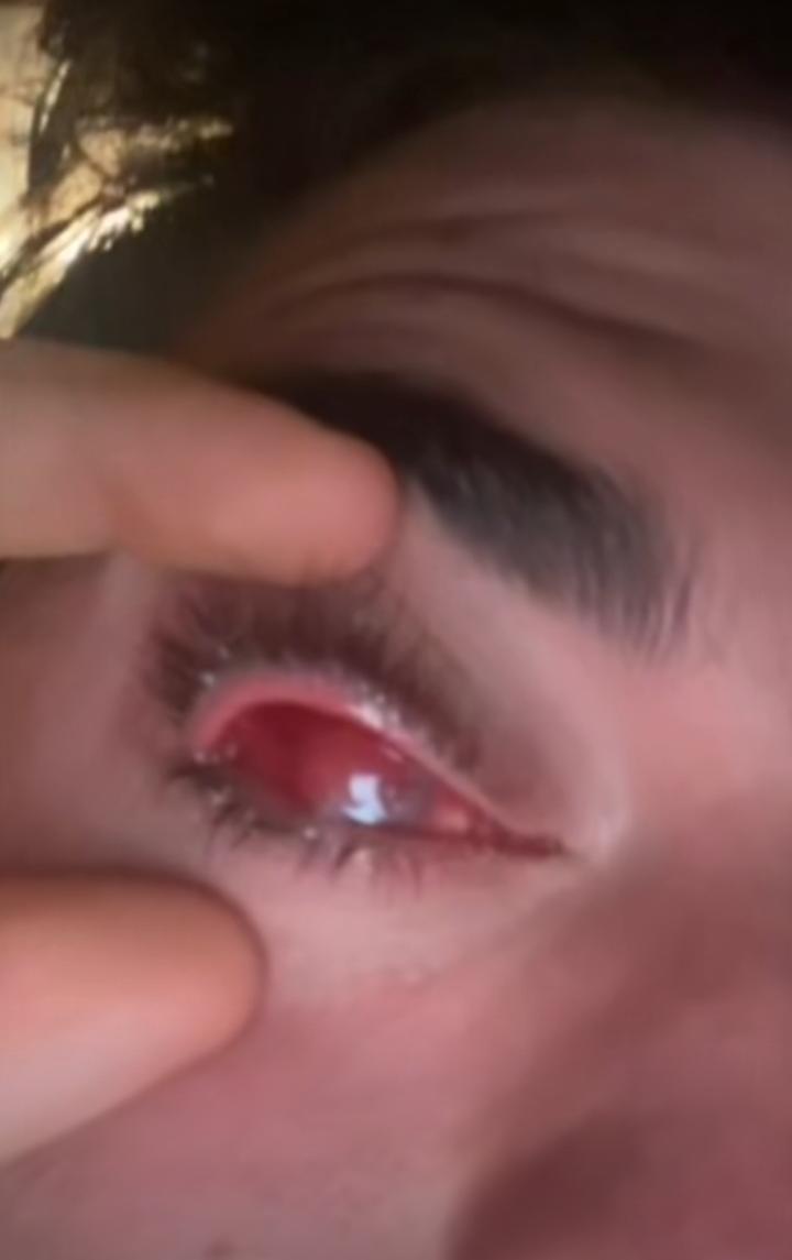 Joven muestra como quedo su cornea tras cirugia ocular