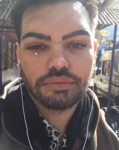 Hombre trata de parecerse a Ricky Martin y termina desfigurado